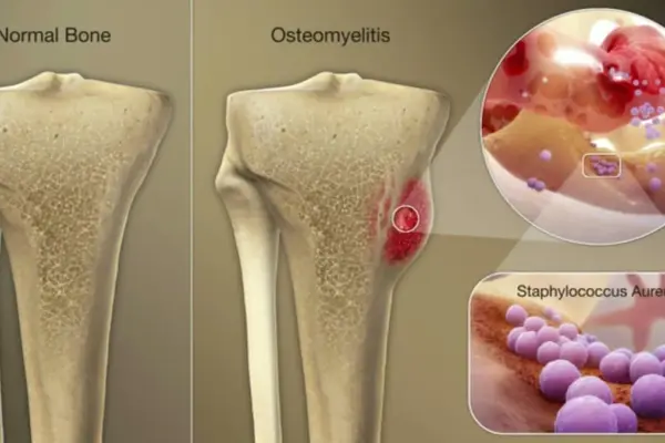 οστεομυελίτιδα — GR news
